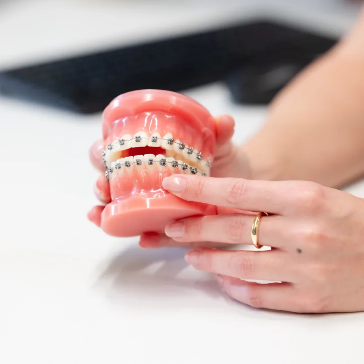 Metal braces being shown on a dental model